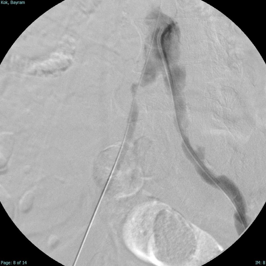 Türkiye’nin ilk yerli stent grefti başarıyla hastalara uygulandı