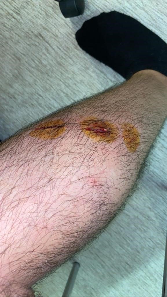 Sokak köpekleri motosikletli gence saldırıp bacağından ısırdı