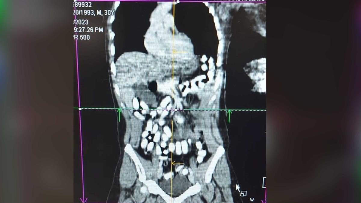 Midesinde 499,23 gram Afyon sakızı taşıyan şahıs tutuklandı