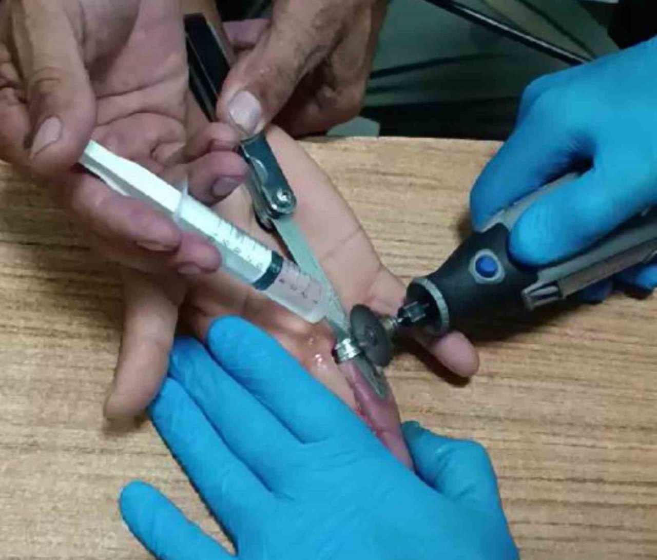 Parmağa sıkışan yüzük kesilerek çıkarıldı