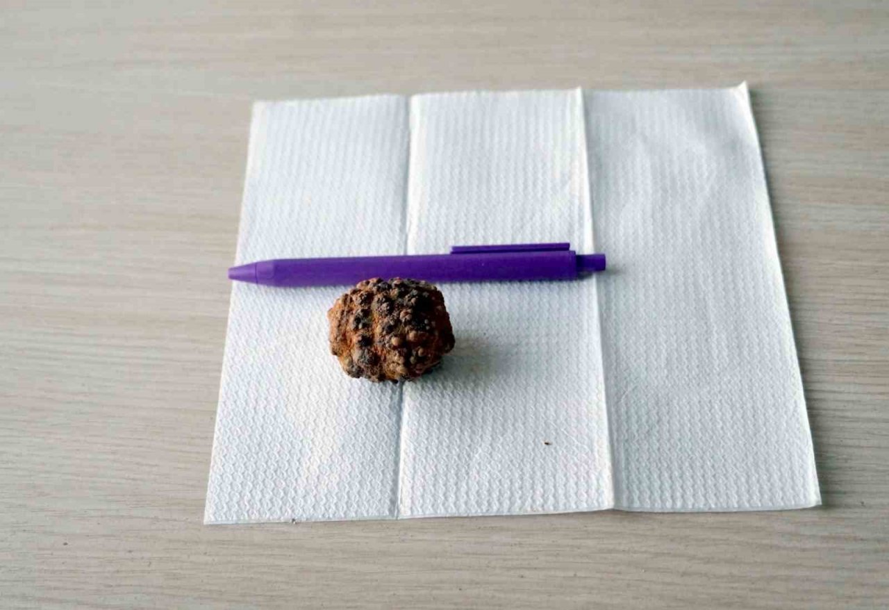 ’Kendi üşer’ diyerek 9 yıldır taşıdığı yumurta büyüklüğündeki taştan ameliyatla kurtuldu