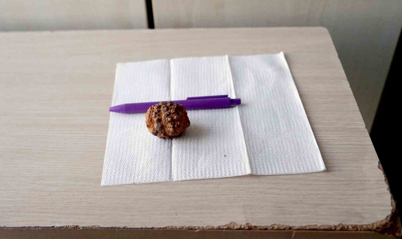 ’Kendi üşer’ diyerek 9 yıldır taşıdığı yumurta büyüklüğündeki taştan ameliyatla kurtuldu