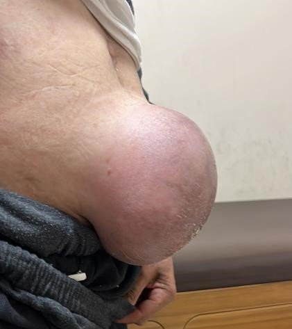 Top büyüklüğünde fıtığı vardı, sağlığına kavuştu