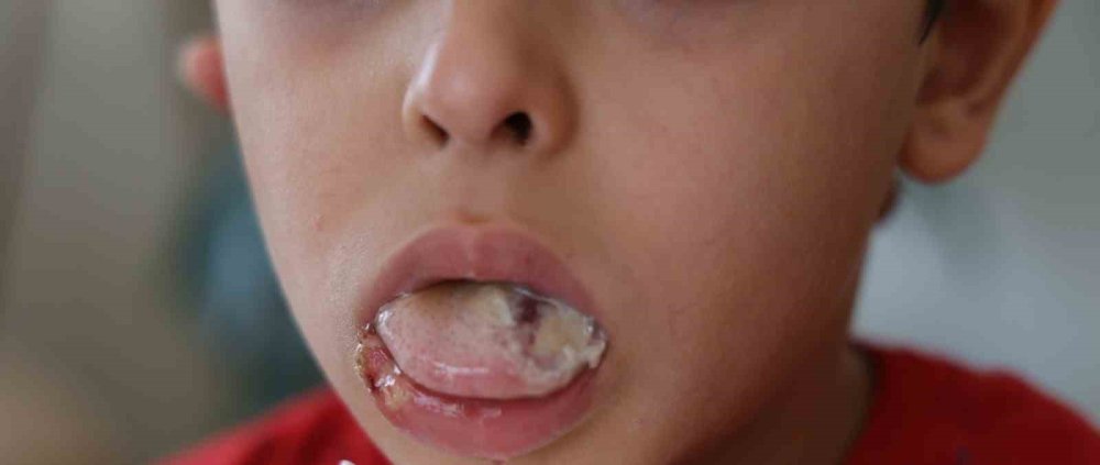 Bademcik ve geniz eti ameliyatı olan çocuğun ameliyatta dili ve dudağı yandı