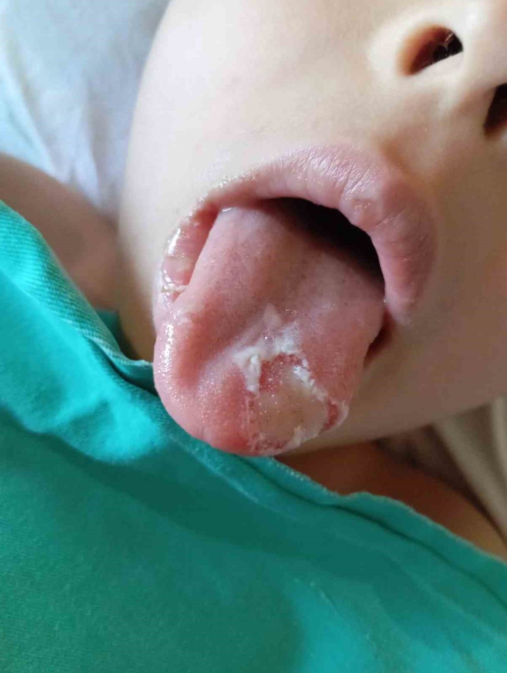 Bademcik ve geniz eti ameliyatı olan çocuğun ameliyatta dili ve dudağı yandı