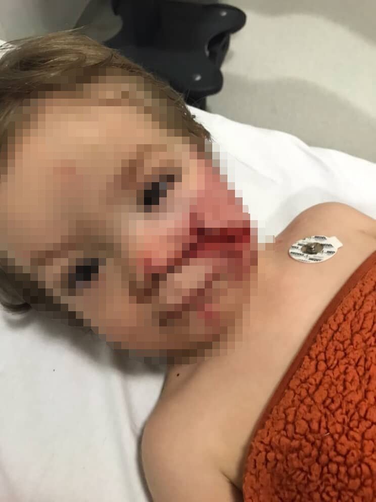 Ankara’da dehşet: Pitbull, çocuğun yüzünü parçaladı