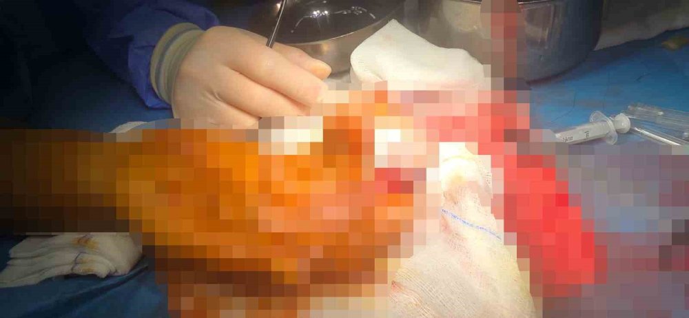 Bulgaristan'da parmağı koptu 14 saat sonra Türkiye'de yerine dikildi