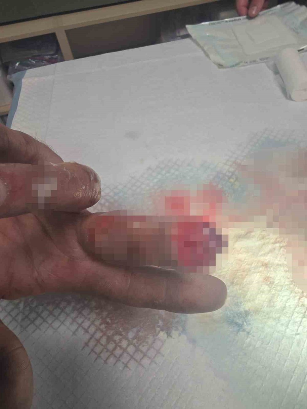 Bulgaristan'da parmağı koptu 14 saat sonra Türkiye'de yerine dikildi