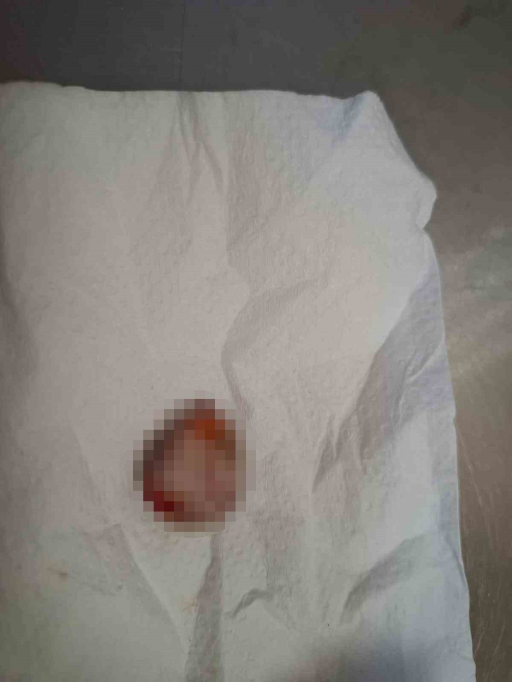 Bulgaristan'da parmağı koptu 14 saat sonra Türkiye'de yerine dikildi