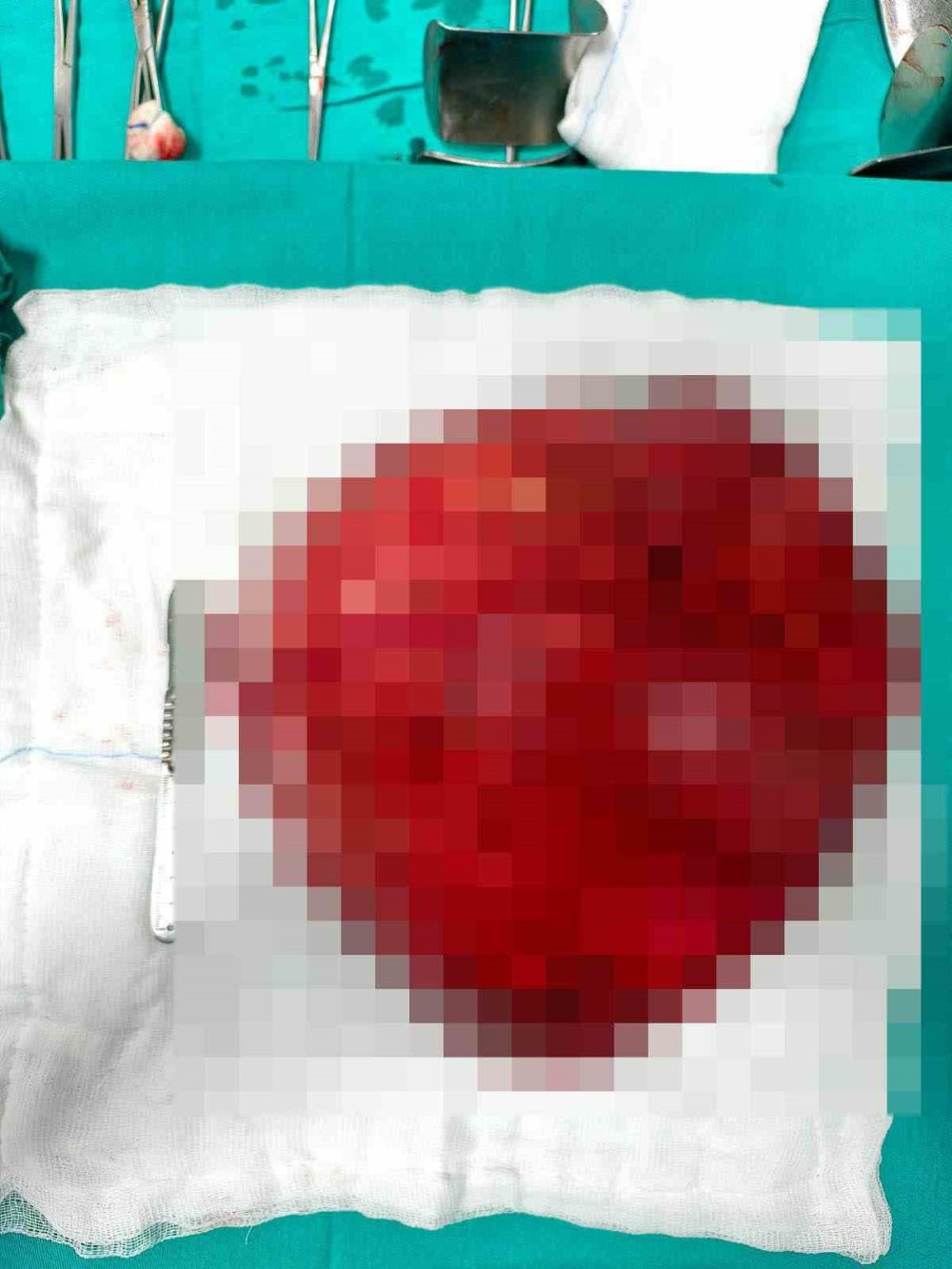 Yıllardır Sinsice Büyümüş: Karın Boşluğunu Dolduran Dev Kitle Çıkarıldı