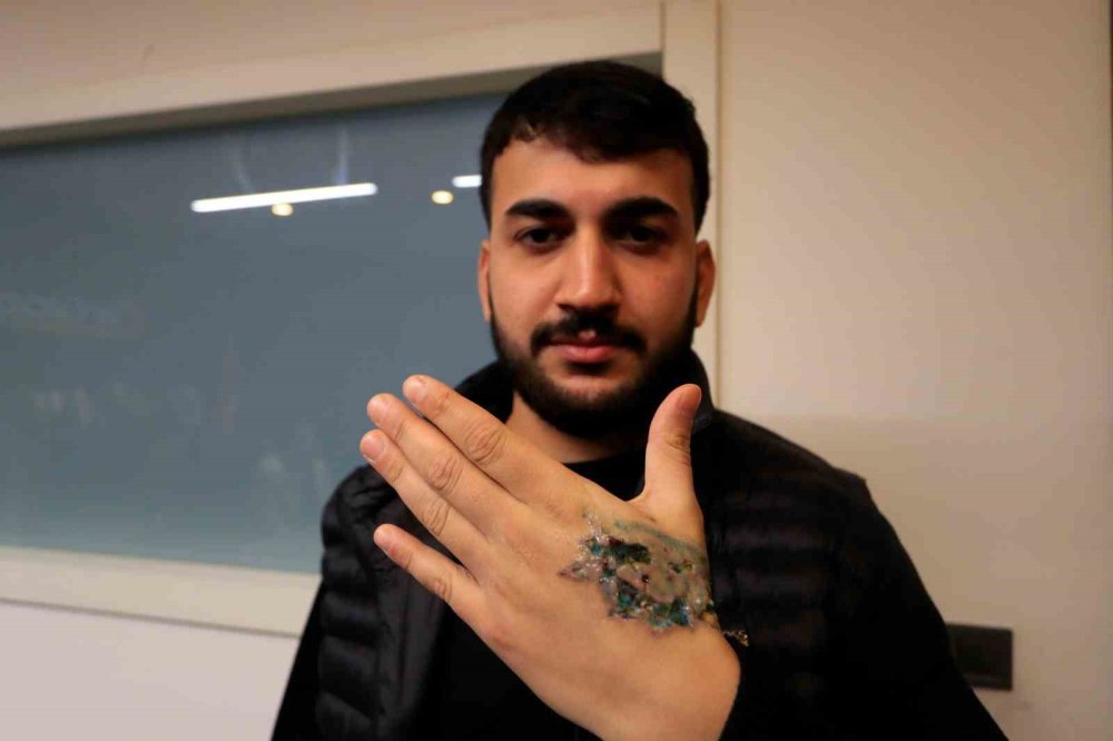 Dövme Silme Seansı Sonrası Hastanelik Oldu! Deri Nakli Olabilir