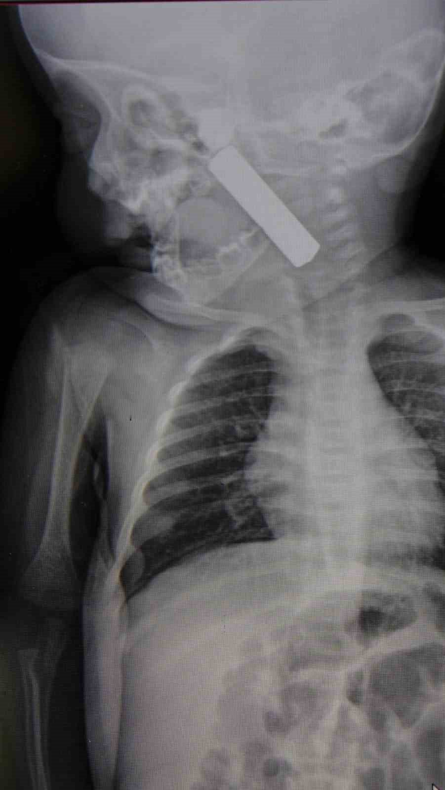 Kumanda pili yutan 6 aylık bebek son anda kurtarıldı