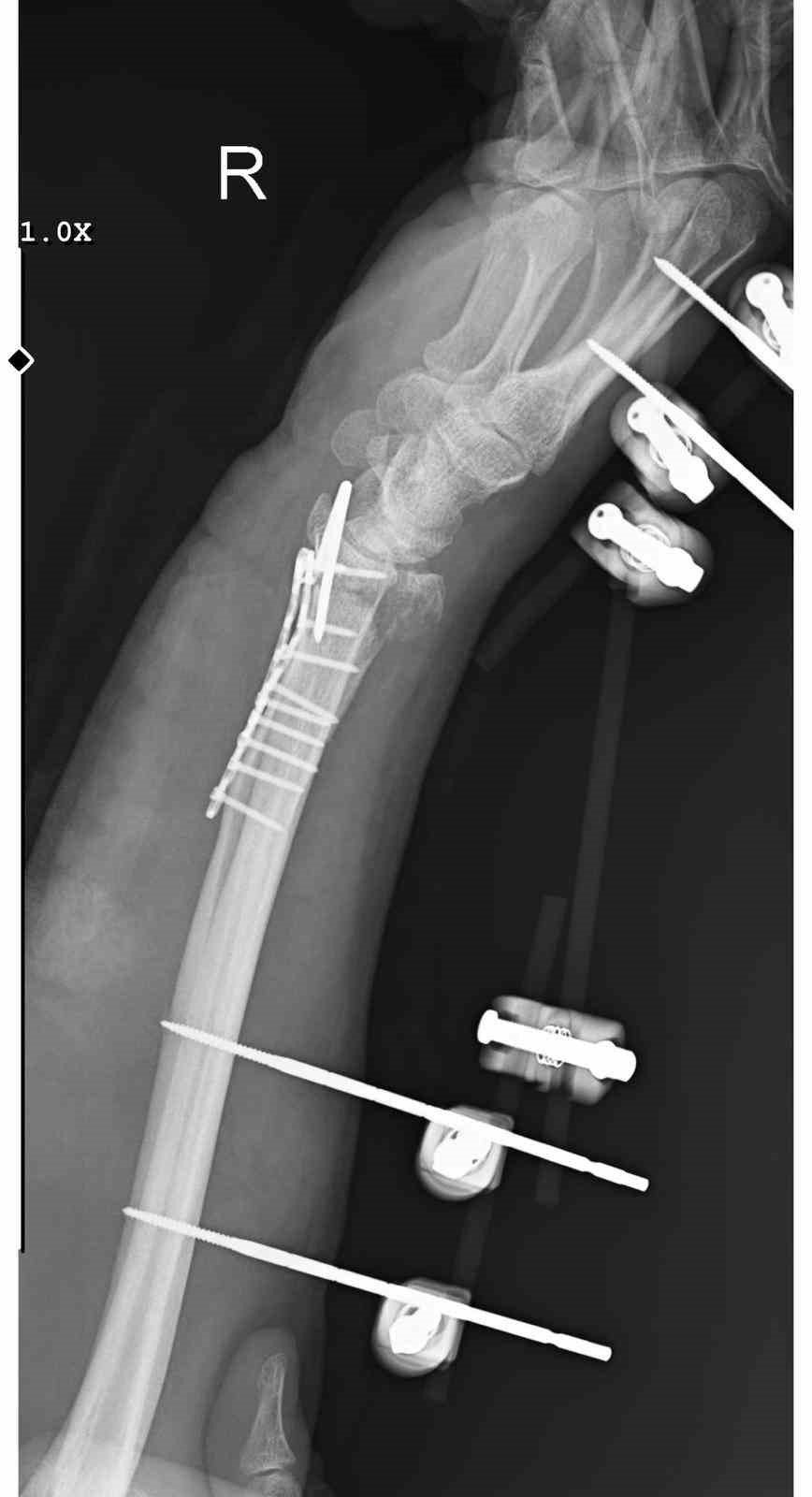 Köpeklerden kaçarken düştü fatura vatandaşa çıktı