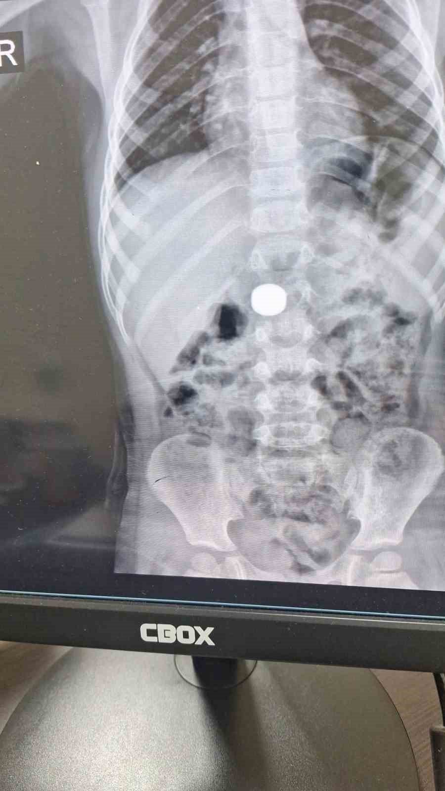 Karaman’da Mıknatıs Yutan Çocuk Ameliyatla Kurtarıldı