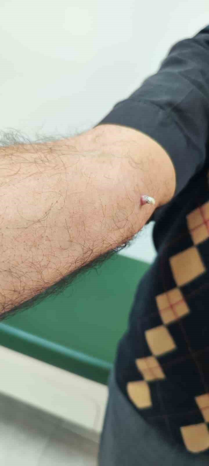 Dirseğindeki Yara Cilt Kanseri Çıktı: Erken Teşhis Hayat Kurtardı