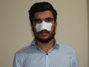 Kavga ettiği kuzeni tarafından burnu ısırılarak koparıldı