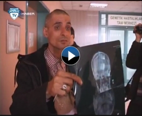 Kafasından 15 yıldır iğne çıkıyor!